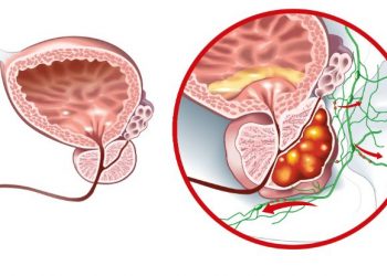 أورن زريف – أعراض سرطان البروستاتا