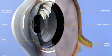 تشير أعراض العين إلى المشاكل التي تنشأ عندما ينسكب داخل العين المملوء بالسوائل (الخلط الزجاجي) ثم يعود إلى العين من خلال عملية تسمى الانسداد.