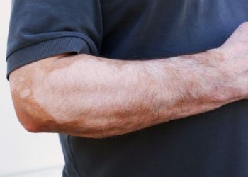 الصدفية هي أحد أمراض المناعة الذاتية تظهر في ظهور بقع حمراء على الجلد ، والتي غالبًا ما تكون مغطاة بالمقاييس.